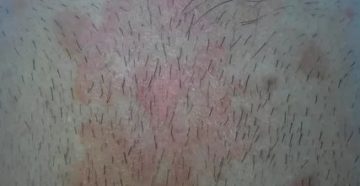 Пятна на лобке, зуд и шелушение