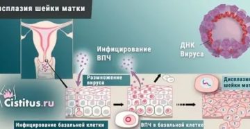 Вирус ВПЧ и дисплазия шейки матки