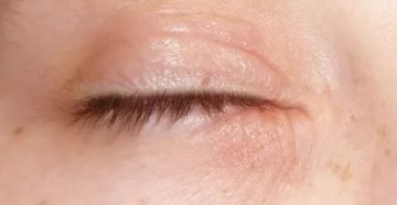 Мелкие водянистые прыщики на веке и зуд