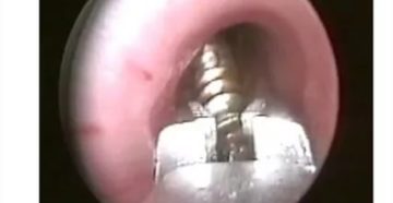 Застряла кожура от гороха в горле