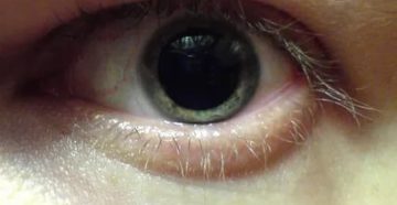 Непроизвольное расширение зрачков после капель для глаз
