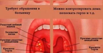Пузырьки в горле без температуры Пузырьки в горле без температуры