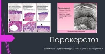 Биопсия шейки матки Очаговый паракератоз