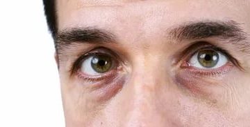 Впавшие глаза