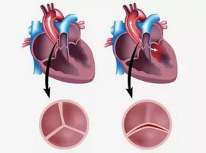 Что делать если в аортальном клапане 2 створки вместо 3?