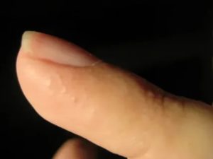 Прозрачные пузырьки на пальцах рук
