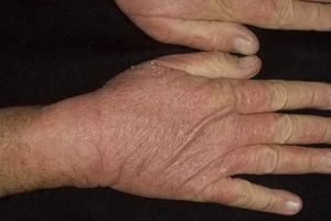 Чем лечить дерматит на кисти руки. Обнаружены споры грибка