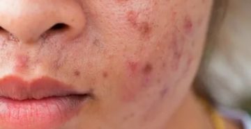 Стрептококк и угри Стрептококк и угри