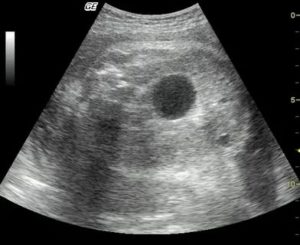 Затемнение в почке