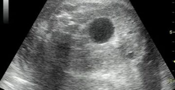 Затемнение в почке Затемнение в почке