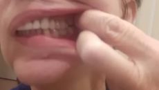 Язык трётся о 7-й нижний зуб, зуб мешает