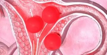 Кровотечение или месячные после чистки и удаления полипа