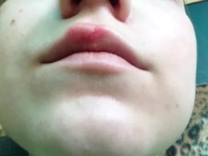 Появление красного пятна над губой