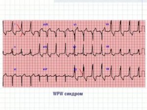 WPW синдром