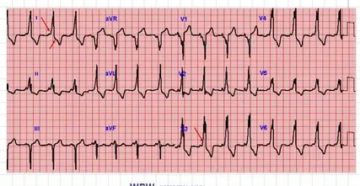WPW синдром