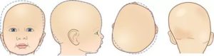 Несимметричный череп у ребенка