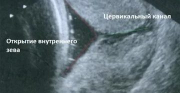 Раскрытие внутреннего зева на 26 неделях. В