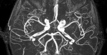 Расшифровка МРТ и МРА, артерии головного мозга