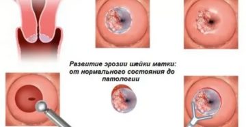 Прижигание эрозии в конце месячных