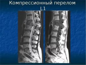 Застарелый компресионный перелом позвонка L 1