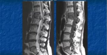 Застарелый компресионный перелом позвонка L 1 Застарелый компресионный перелом позвонка L 1