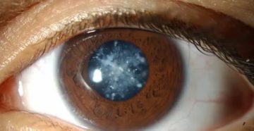 Мутно видит