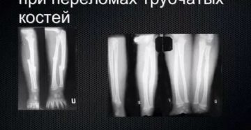 Допустимое смещение кости