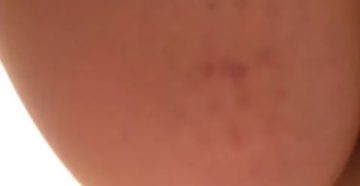 Пятна на ягодицах