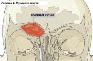 Киста или мукоцеле носового синуса