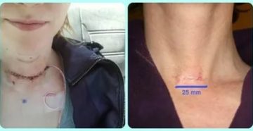 Пропал голос после удаления щитовидной железы