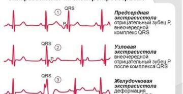 Экстрасистолы