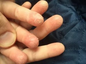 Лопается и облазит кожа на пальцах