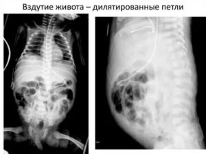 Дилатированные петли кишечника