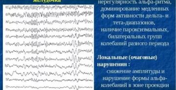 Расшифровка ЭЭГ. ВГСД. Опухоль
