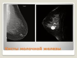 Киста груди 6 мм