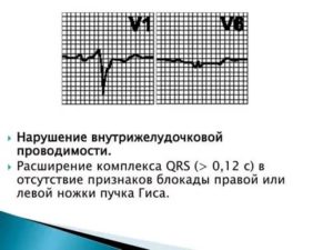 Нарушение вн. Желудочковой проводимости у подростка. Жалоб нет