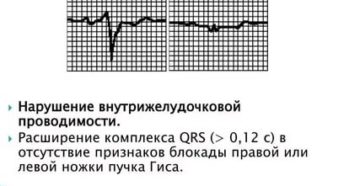 Нарушение вн. Желудочковой проводимости у подростка. Жалоб нет