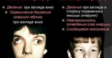 Двоение глаза при взгляде вверх и вниз Двоение глаза при взгляде вверх и вниз