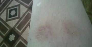 Пятно на ноге шелушится