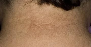 Пятна на шее коричневого цвета!