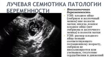 Не лоцируется эмбрион