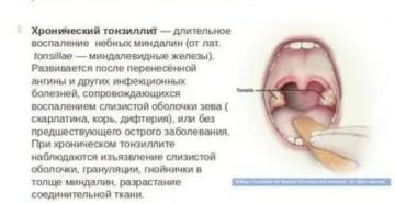 Пробки на миндалинах при беременности Пробки на миндалинах при беременности