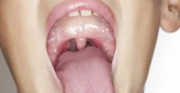 Воспаление язычка