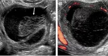 Киста левого яичника с кровоизлиянием в стадии регресса