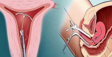 После спирали не могу забеременеть