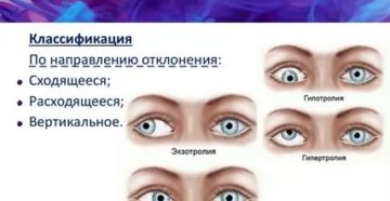 Противопоказания при содружественном расходящем косоглазии, профессии и водительские права