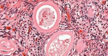 Боль при мультифолликулярных яичниках