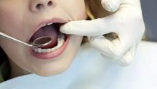 Рак полости рта, удаление зубов