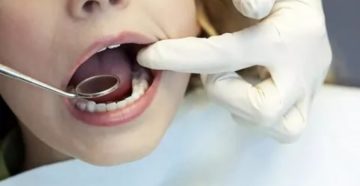 Рак полости рта, удаление зубов