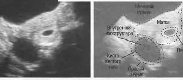 Беременность в одном цикле с кистой желтого тела